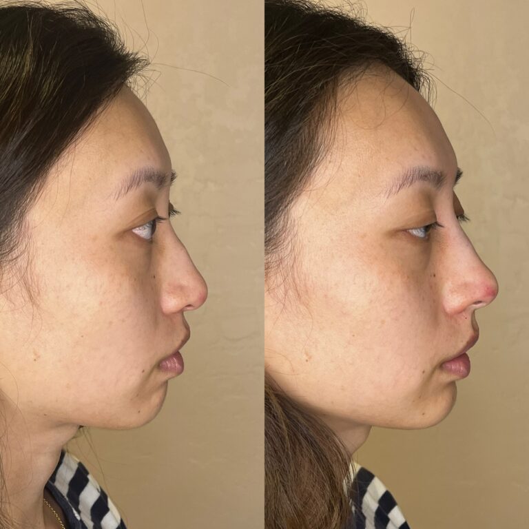 Desert Bloom patient — Non-surgical rhinoplasty result, case 1
