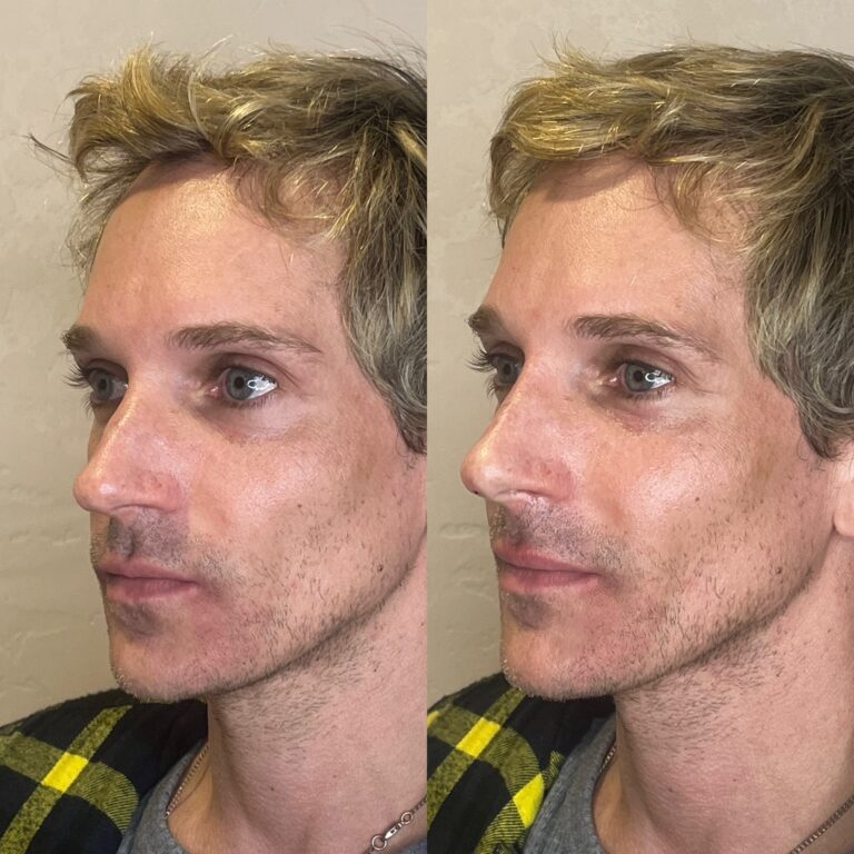 Desert Bloom patient — Non-surgical rhinoplasty result, case 11
