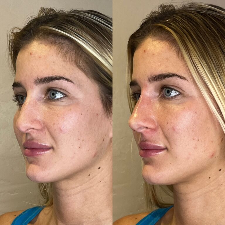 Desert Bloom patient — Non-surgical rhinoplasty result, case 12