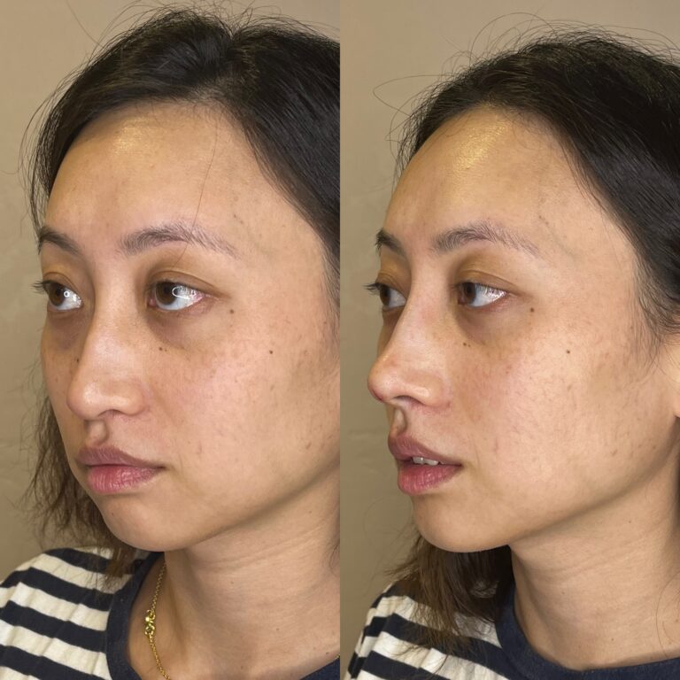 Desert Bloom patient — Non-surgical rhinoplasty result, case 14