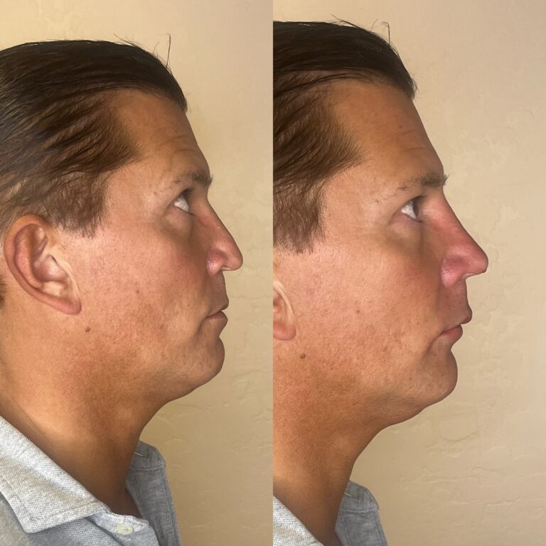 Desert Bloom patient — Non-surgical rhinoplasty result, case 15