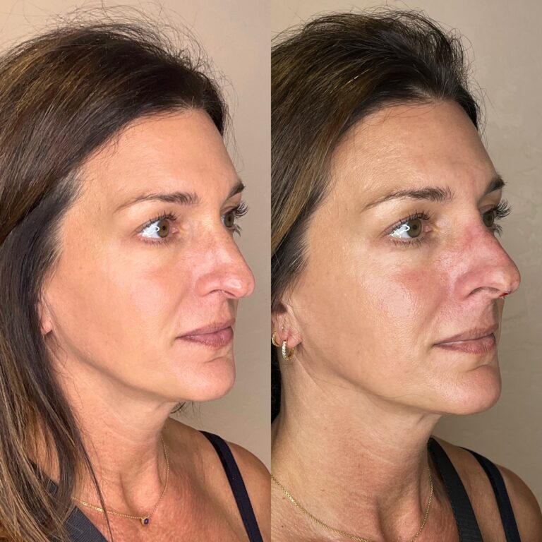 Desert Bloom patient — Non-surgical rhinoplasty result, case 18