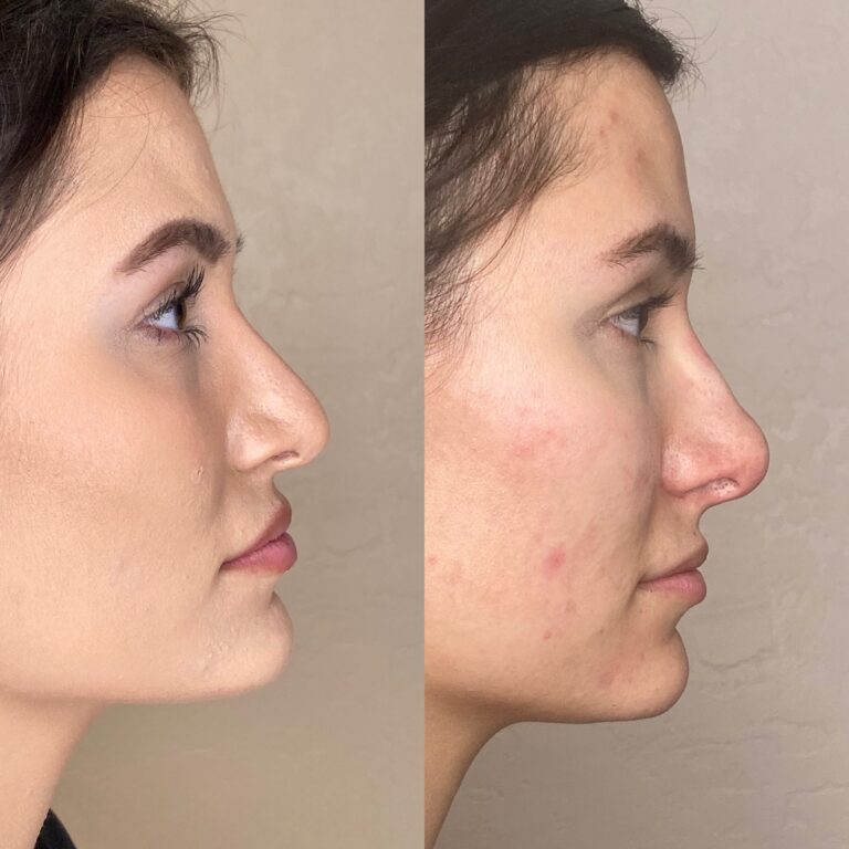 Desert Bloom patient — Non-surgical rhinoplasty result, case 19
