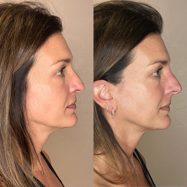 Desert Bloom patient — Non-surgical rhinoplasty result, case 2