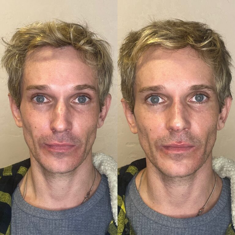 Desert Bloom patient — Non-surgical rhinoplasty result, case 21