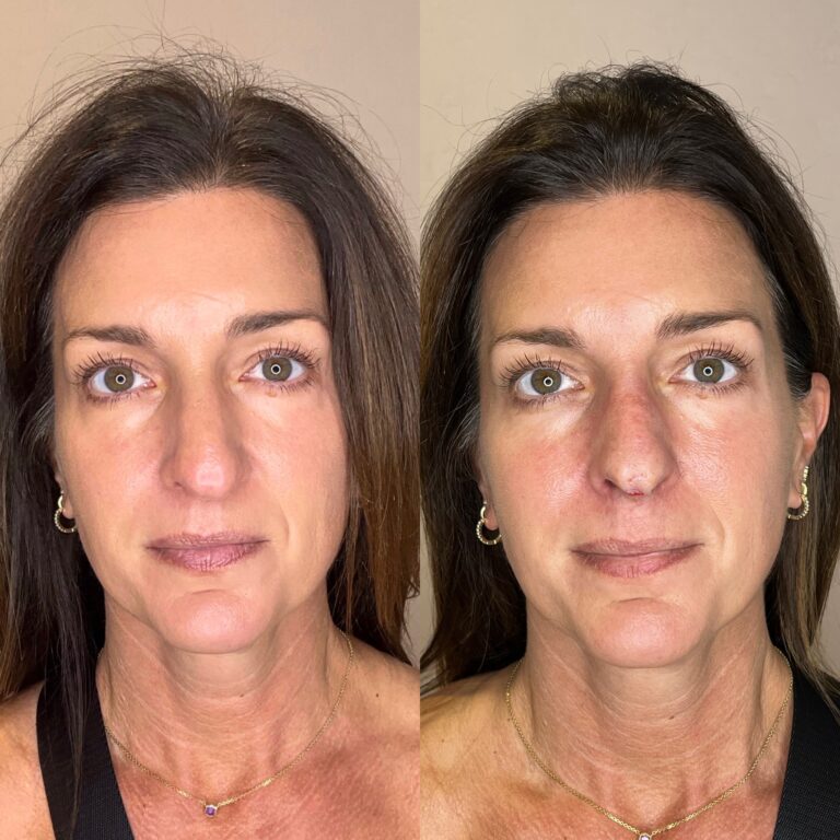 Desert Bloom patient — Non-surgical rhinoplasty result, case 24