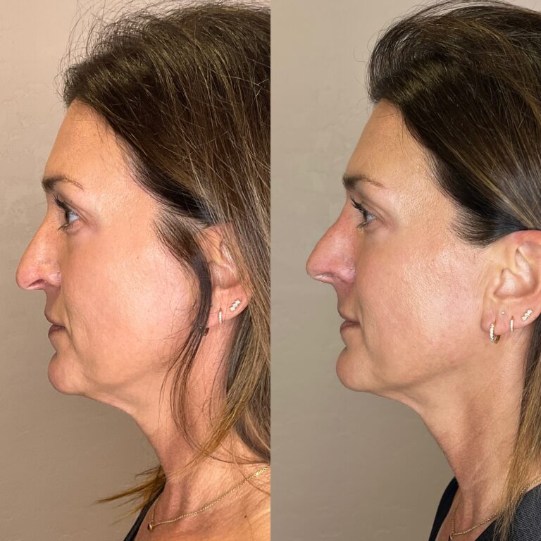 Desert Bloom patient — Non-surgical rhinoplasty result, case 26