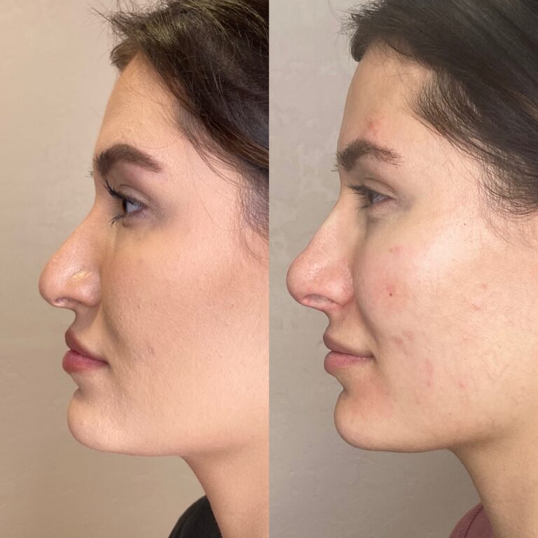 Desert Bloom patient — Non-surgical rhinoplasty result, case 28
