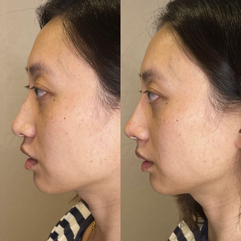 Desert Bloom patient — Non-surgical rhinoplasty result, case 29