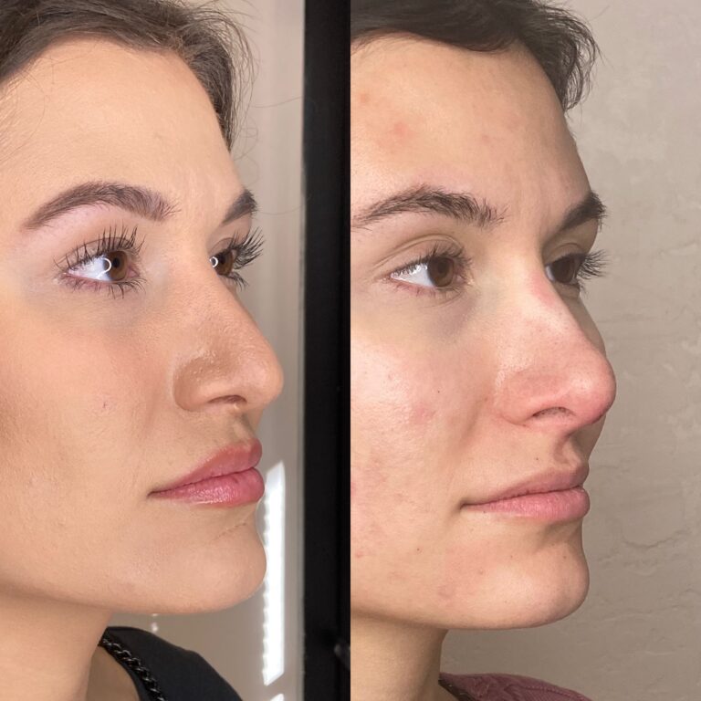 Desert Bloom patient — Non-surgical rhinoplasty result, case 3
