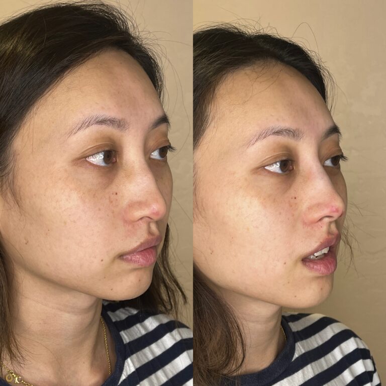 Desert Bloom patient — Non-surgical rhinoplasty result, case 30