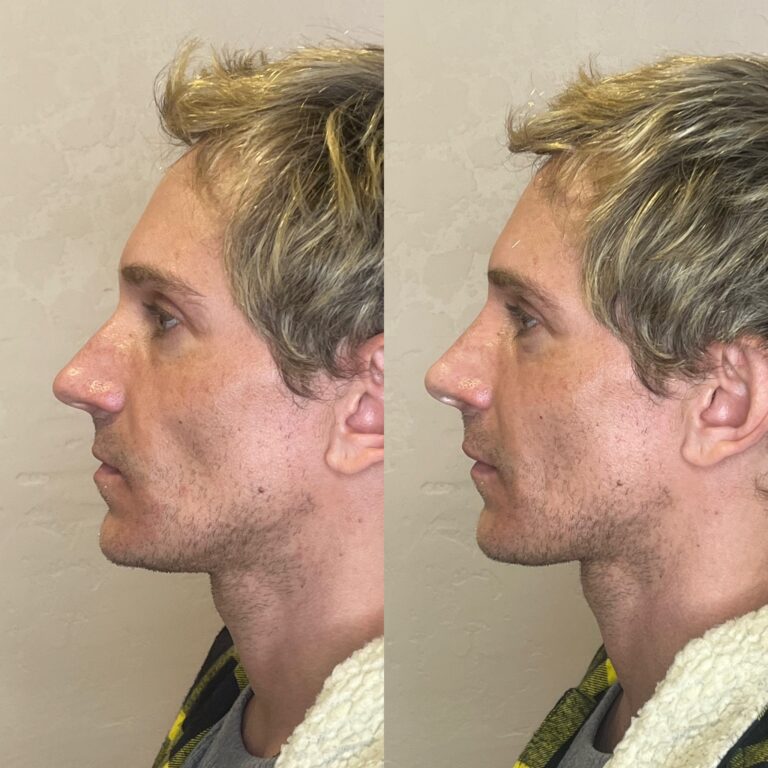 Desert Bloom patient — Non-surgical rhinoplasty result, case 31