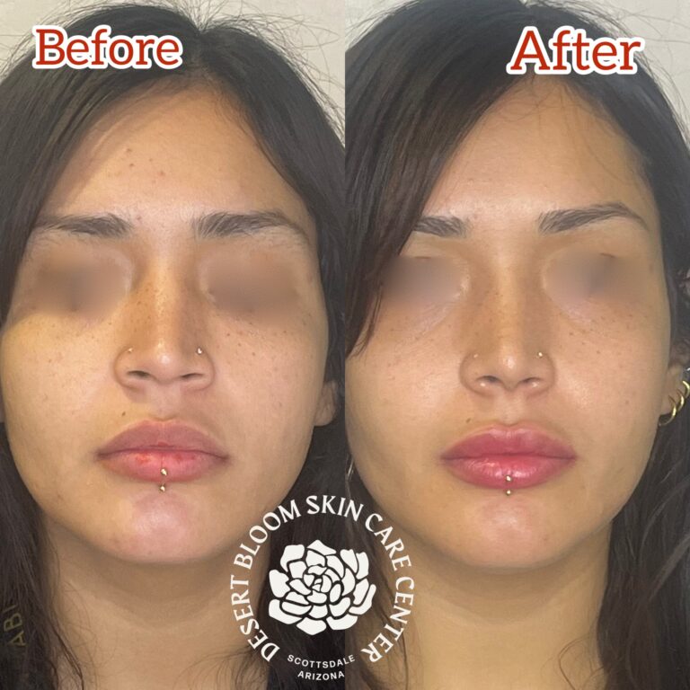 Desert Bloom patient — Non-surgical rhinoplasty result, case 35