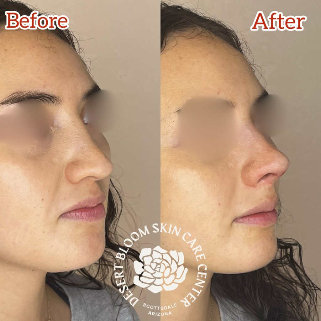 Non-Surgical Rhinoplasty result 1