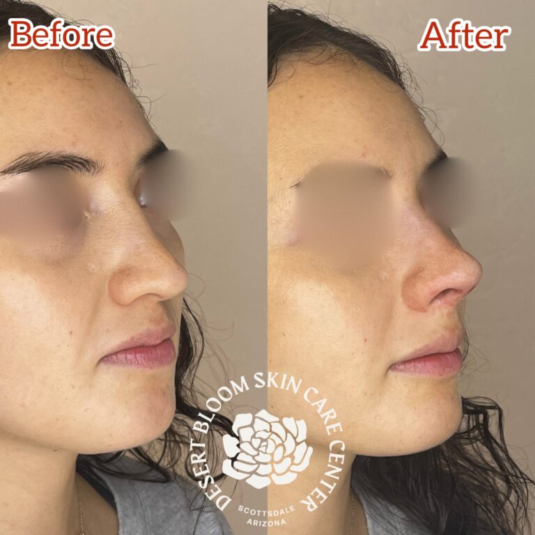 Desert Bloom patient — Non-surgical rhinoplasty result, case 36