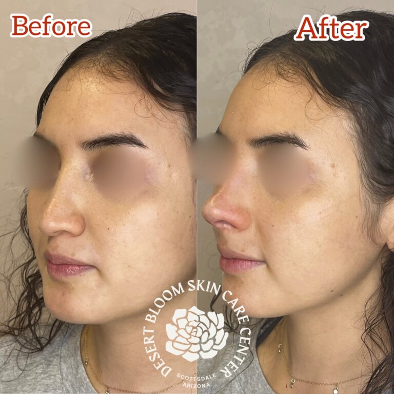 Desert Bloom patient — Non-surgical rhinoplasty result, case 37