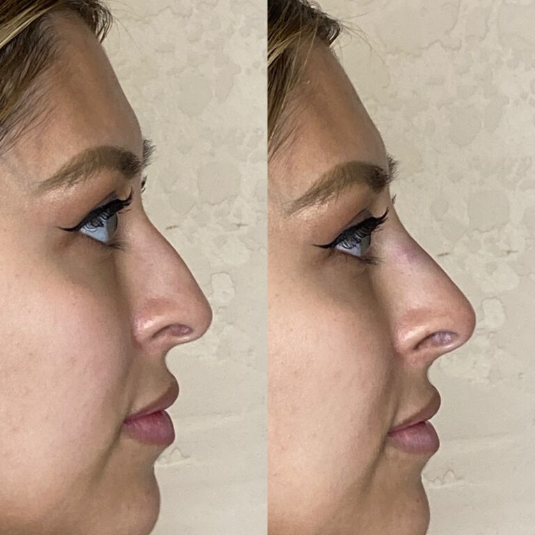 Desert Bloom patient — Non-surgical rhinoplasty result, case 4