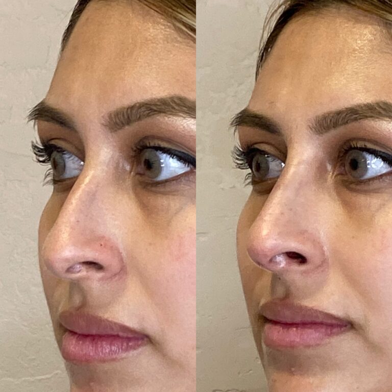 Desert Bloom patient — Non-surgical rhinoplasty result, case 5