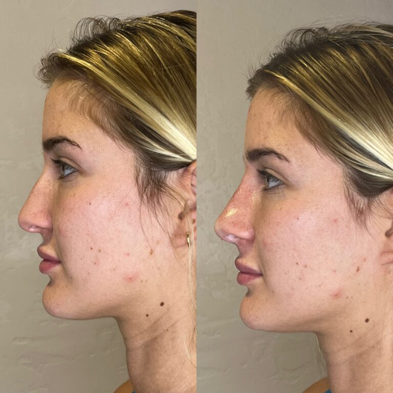 Desert Bloom patient — Non-surgical rhinoplasty result, case 6