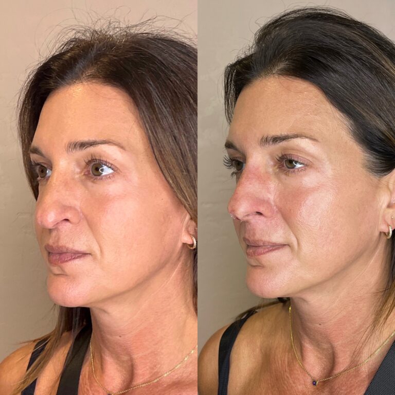 Desert Bloom patient — Non-surgical rhinoplasty result, case 7