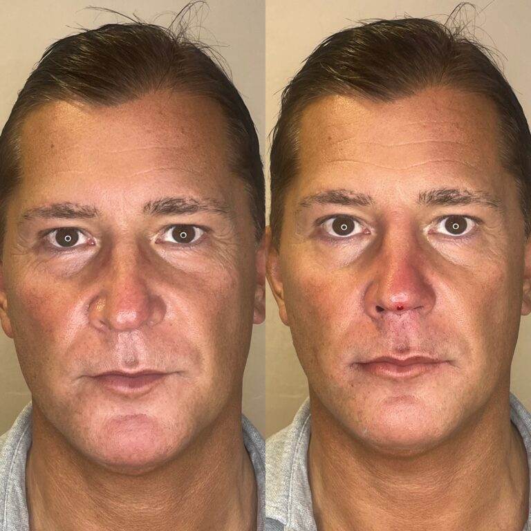 Desert Bloom patient — Non-surgical rhinoplasty result, case 8