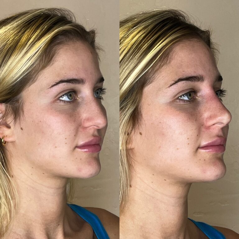 Desert Bloom patient — Non-surgical rhinoplasty result, case 9