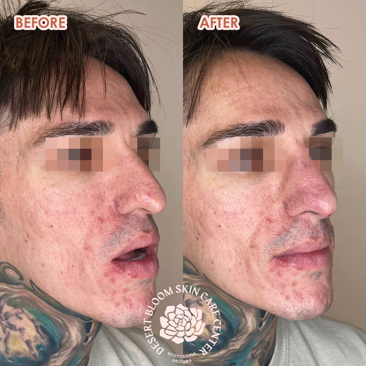 Before and after PDO thread nose tip lift for men, left profile