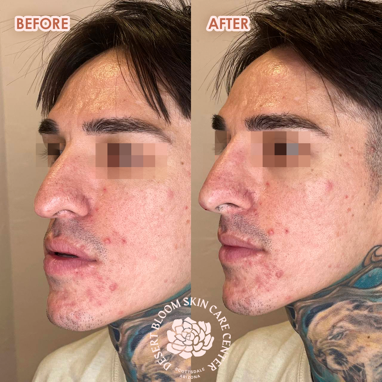 Before and after PDO thread nose tip lift for men, right profile