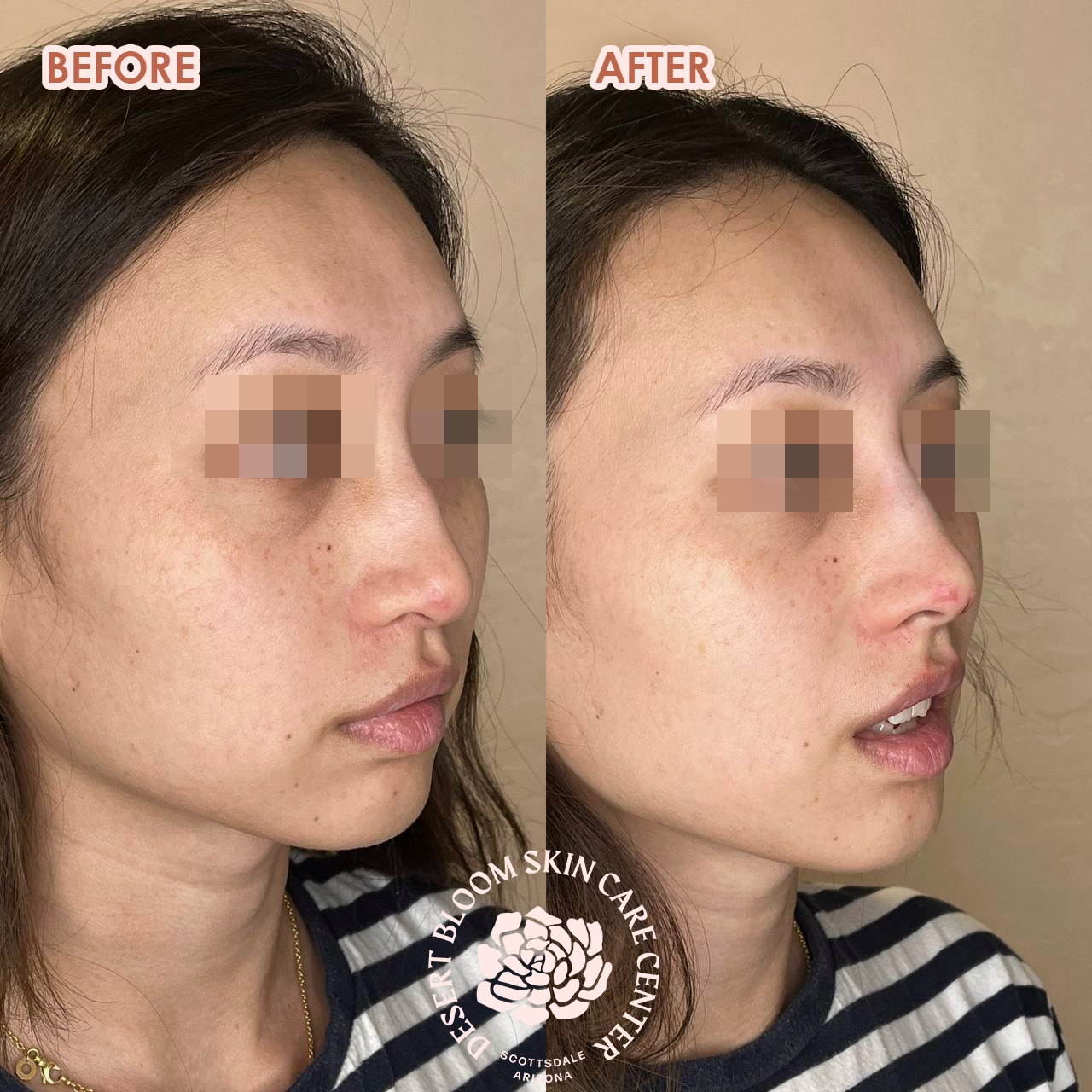 Before and after PDO thread nose tip lift for women, front left view