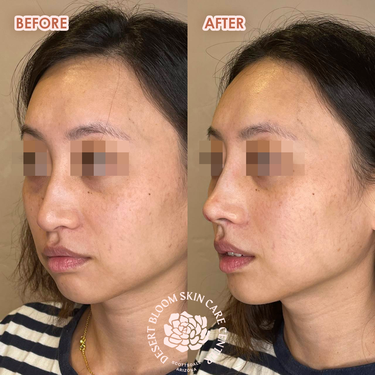 Before and after PDO thread nose tip lift for women, front right view