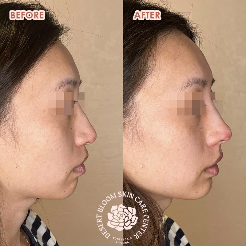 Before and after PDO thread nose tip lift for women, left profile