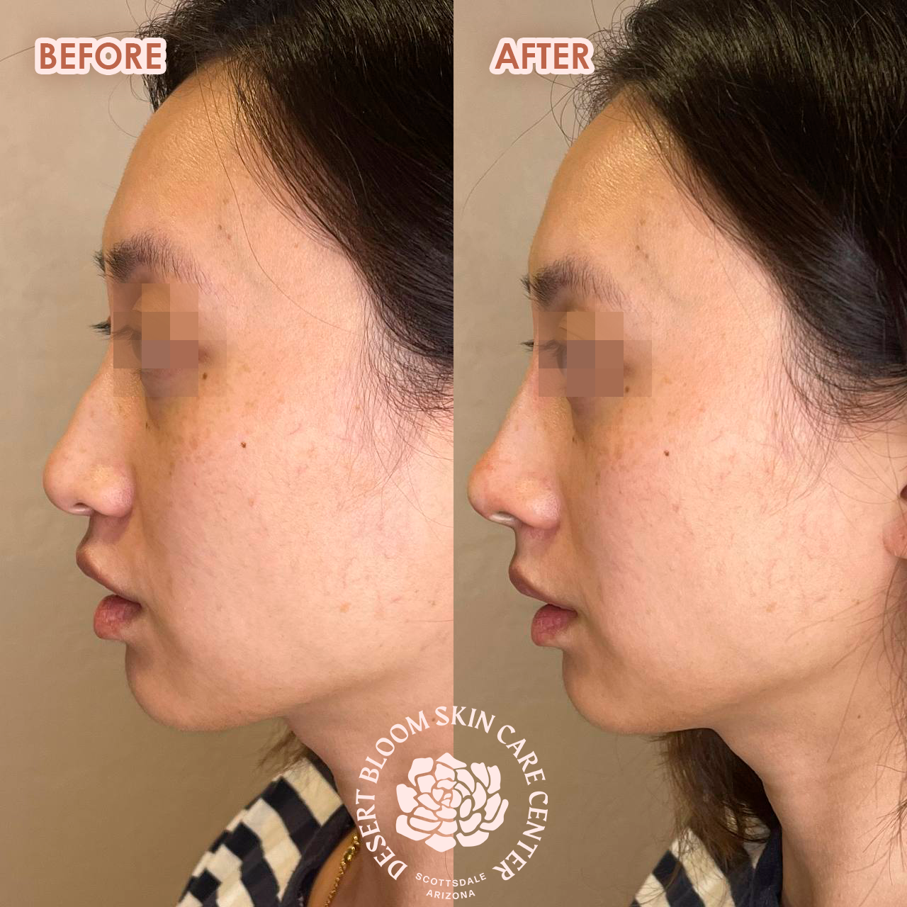 Before and after PDO thread nose tip lift for women, right profile