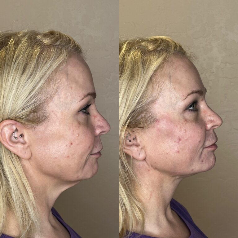 Desert Bloom patient — PDO thread lift result, case 1