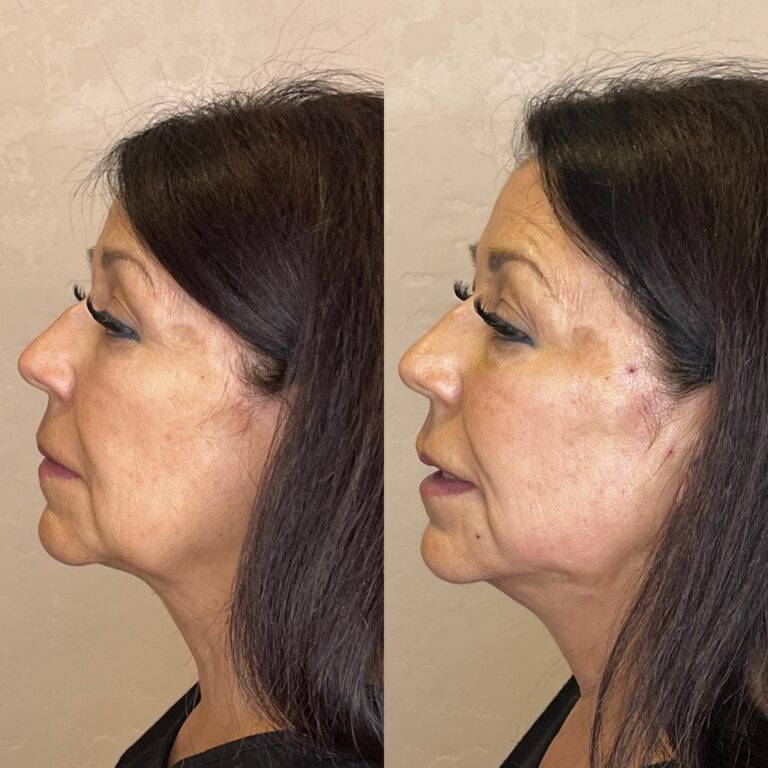 Desert Bloom patient — PDO thread lift result, case 10