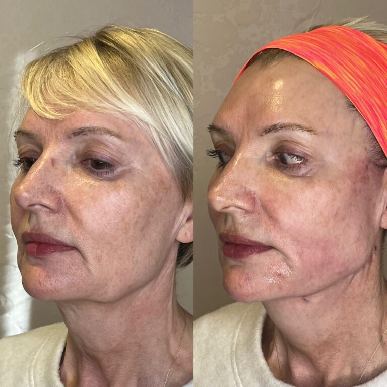 Desert Bloom patient — PDO thread lift result, case 12