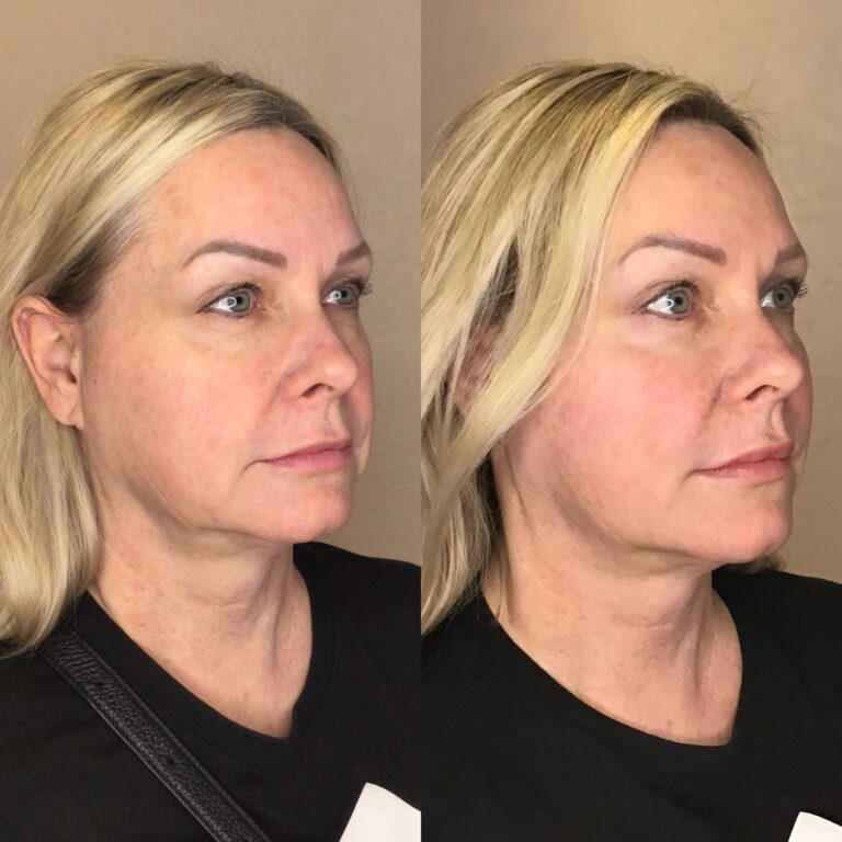 Desert Bloom patient — PDO thread lift result, case 13