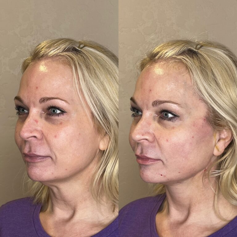 Desert Bloom patient — PDO thread lift result, case 14