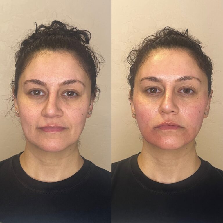 Desert Bloom patient — PDO thread lift result, case 15