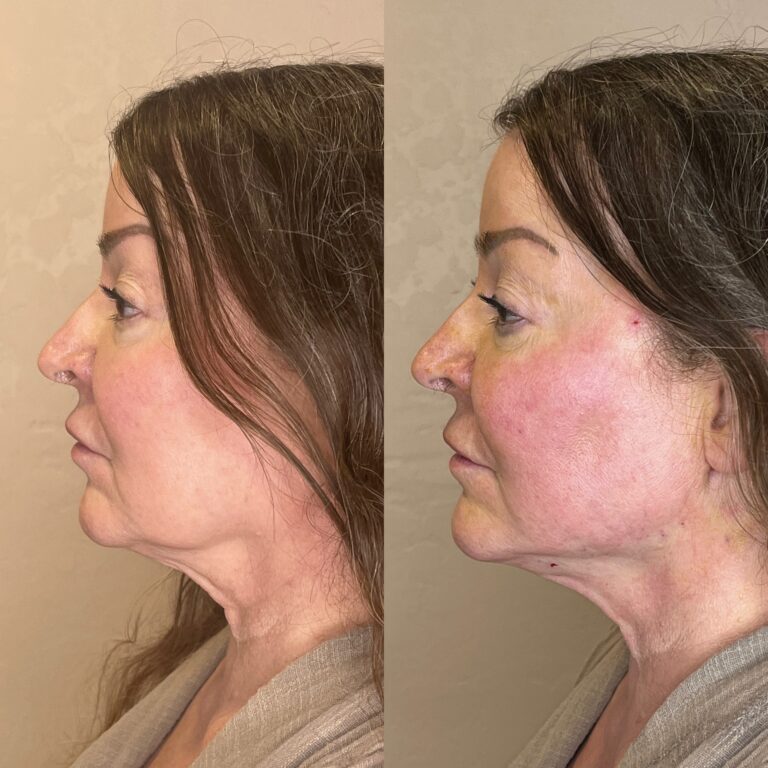 Desert Bloom patient — PDO thread lift result, case 17