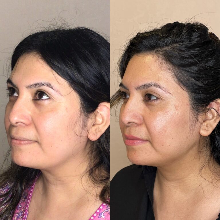 Desert Bloom patient — PDO thread lift result, case 18