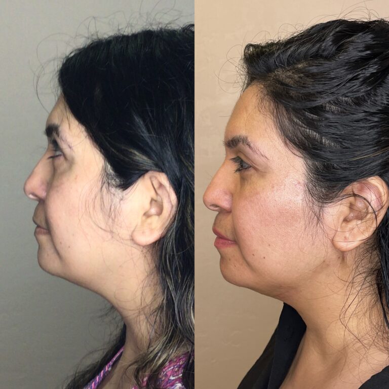 Desert Bloom patient — PDO thread lift result, case 19