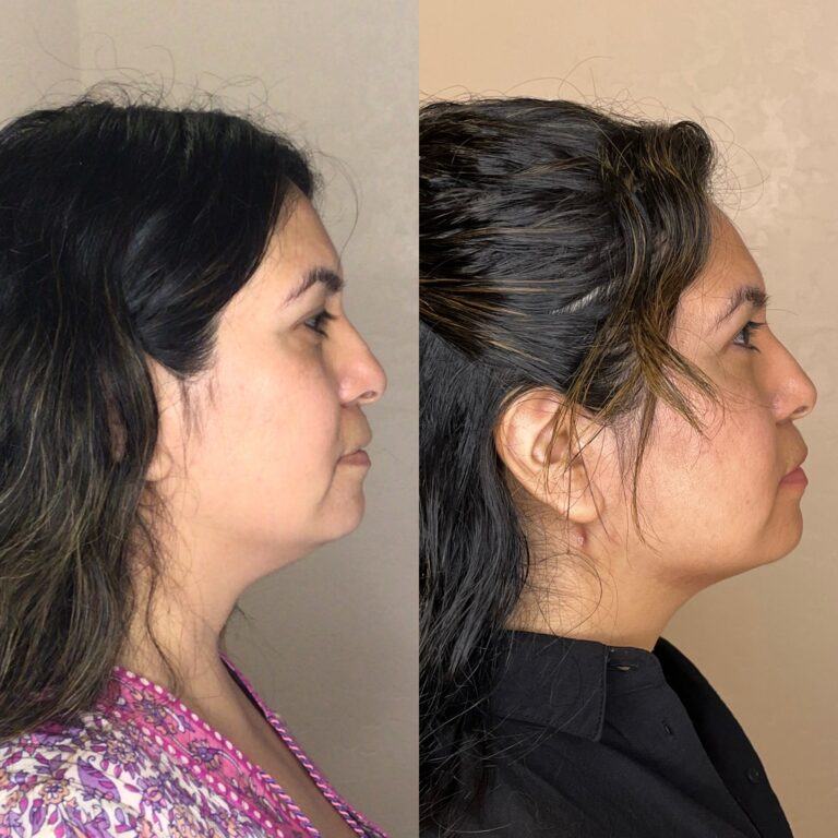 Desert Bloom patient — PDO thread lift result, case 20