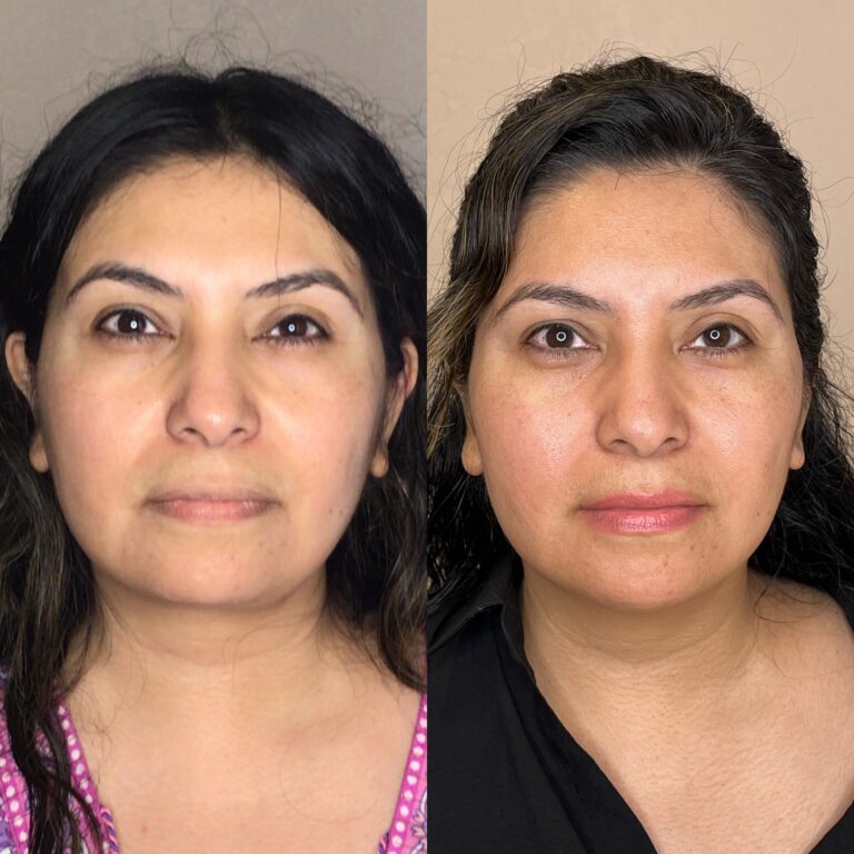 Desert Bloom patient — PDO thread lift result, case 21