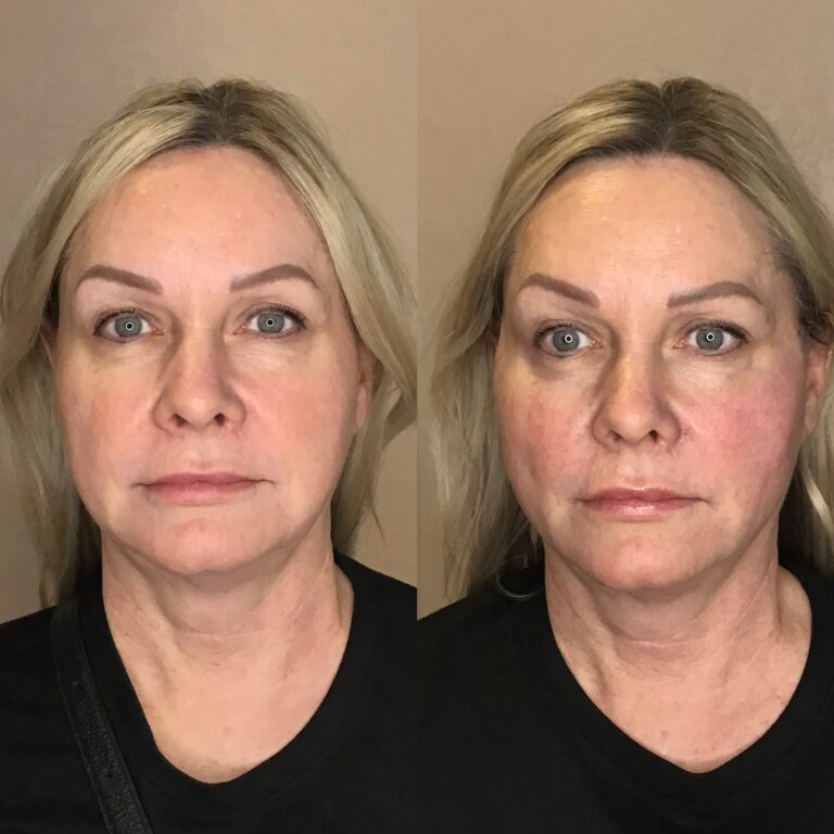 Desert Bloom patient — PDO thread lift result, case 22