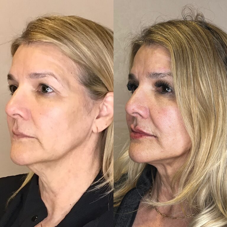 Desert Bloom patient — PDO thread lift result, case 24