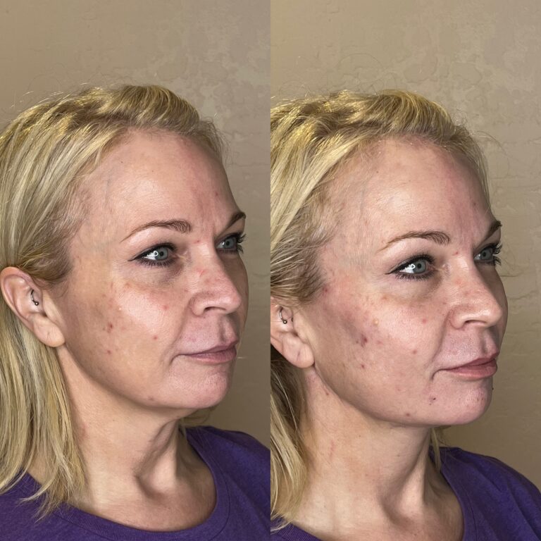 Desert Bloom patient — PDO thread lift result, case 25