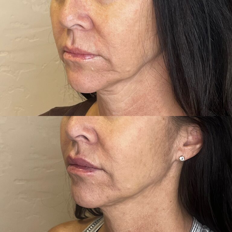 Desert Bloom patient — PDO thread lift result, case 26