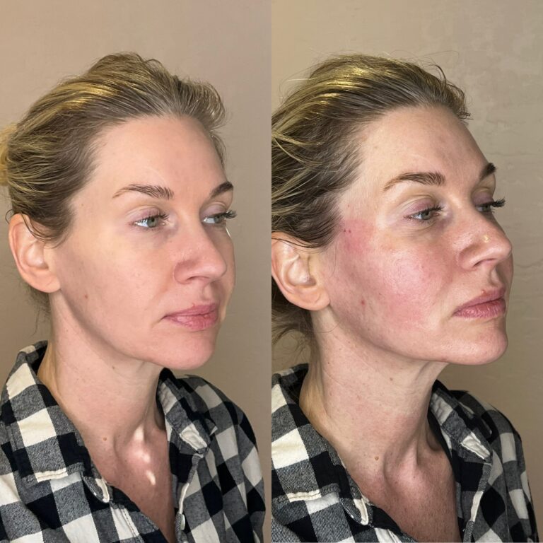 Desert Bloom patient — PDO thread lift result, case 28