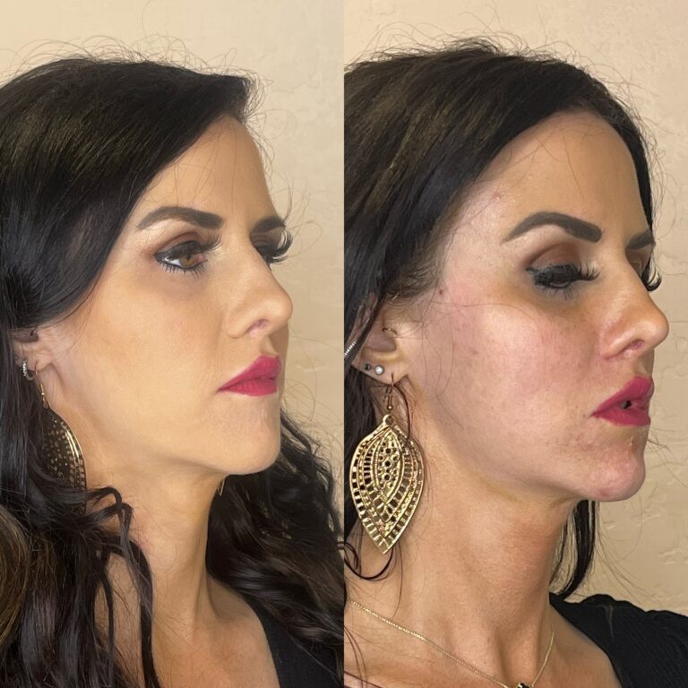 Desert Bloom patient — PDO thread lift result, case 29