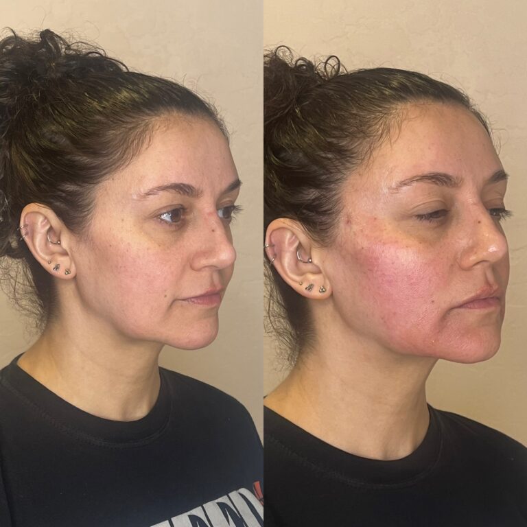 Desert Bloom patient — PDO thread lift result, case 30